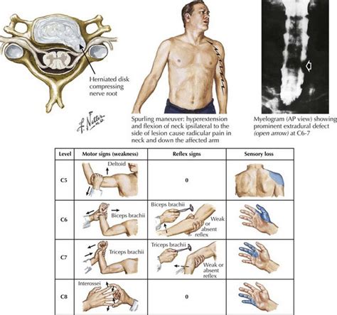 cervical radiculopathy compression test|cervical radiculopathy fact sheet.